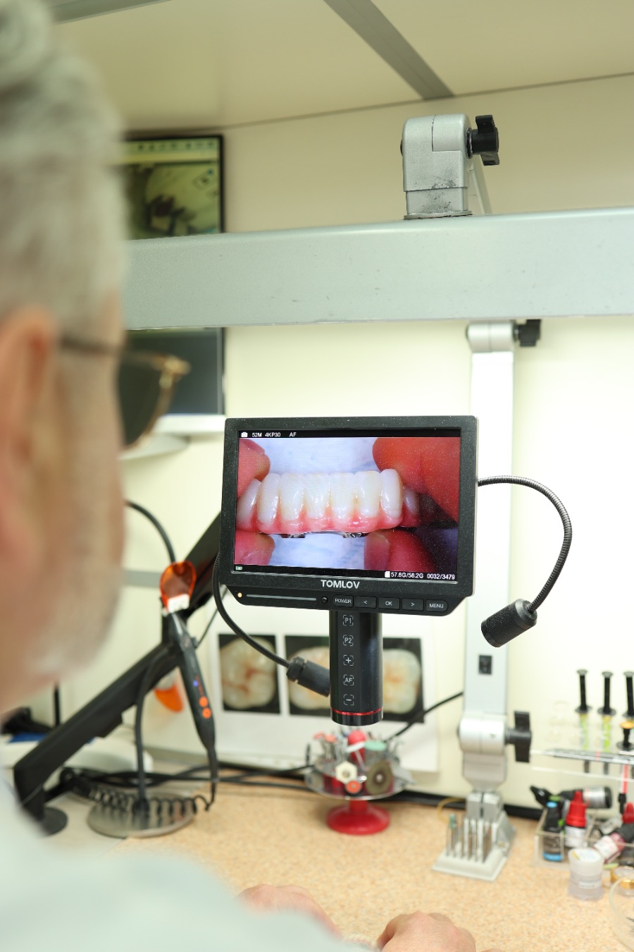 Изготовление протеза в собственной лаборатории BioDent