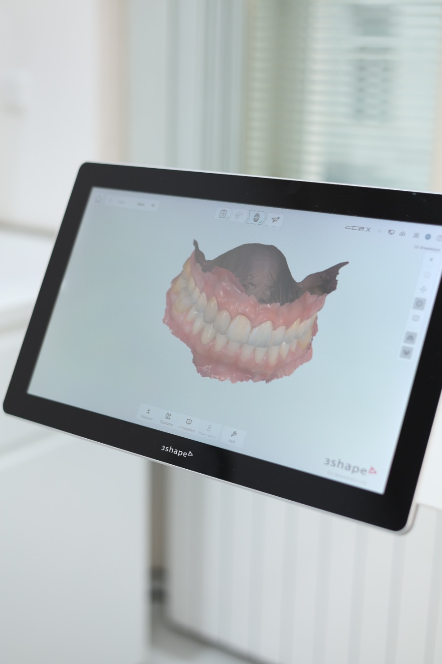 Цифровое сканирование зубов и 3D-модель челюсти в клинике BioDent